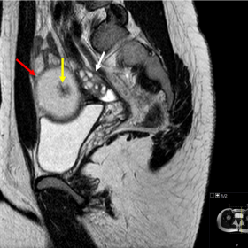 Sagittal T2-weighted image shows a large high signal intensity cystic mass (red arrow) with a nodular, low signal intensity component (yellow arrow). Normal left ovary with follicles (white arrow) is seen posteriorly – negative beak sign.