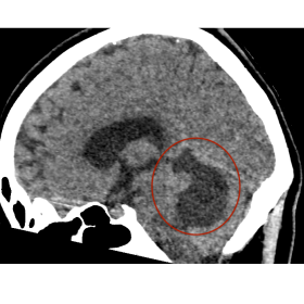 Sagittal CT images identifying a rounded, well-defined intraaxial lesion with a cystic appearance and a solid mural nodule ce