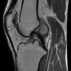 Sagittal view of DP-weighted MRI shows an intraarticular nodular lesion posterior to the posterior cruciate ligament with hig