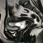 MRI sagittal T2 image showing bulky uterus with anterior uterine myometrial defect and a high signal intensity cystic structure within the defect. The cystic structure is extending into the uterine canal. Minimal pelvic collection is also noted.
