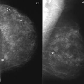 Left breast mammogram - 1995