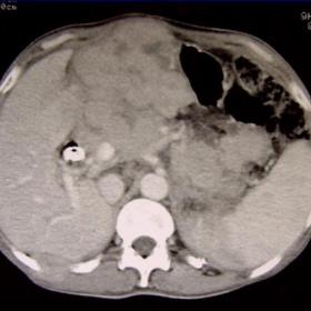 CT  scan pancreas