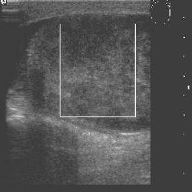 Ultrasound of the affected testis