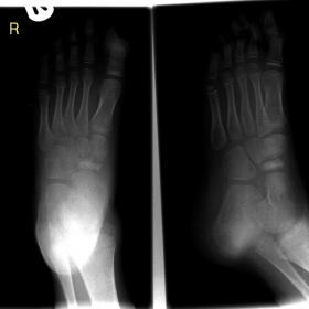 AP/oblique views of the right foot