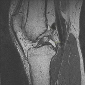 Sagittal section: knee