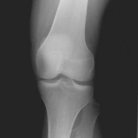 AP/lateral view of left knee