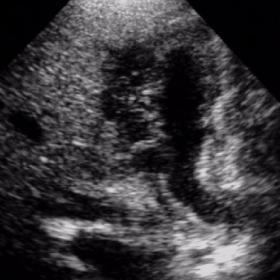 Gallbladder ultrasound