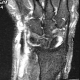 Wrist T2-W MRI