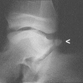 Lateral radiograph of the left ankle