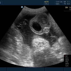 In utero diagnosis of hydrocele