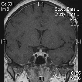 Pituitary MRI: post gadolinium sequences.