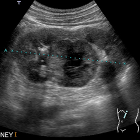 Ultrasound scan of the left kidney