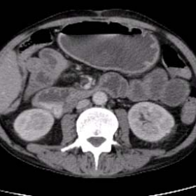 Abdomino Pelvic Angio CT - axial