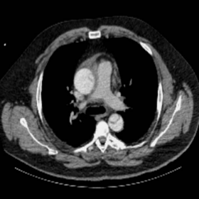 Chest CT - axial