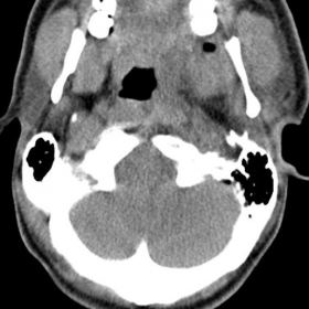 Neck CT examination performed the first day of hospitalisation