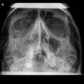 Radiograph of facial bones