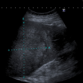 Ultrasound of the liver