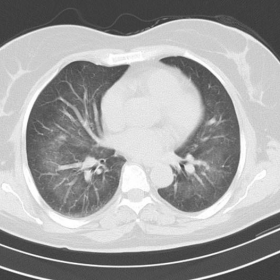 Chest CT examination. Axial CT images in lung window.