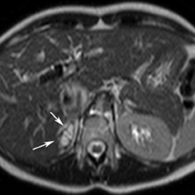 Axial TSE-T2 weighted image