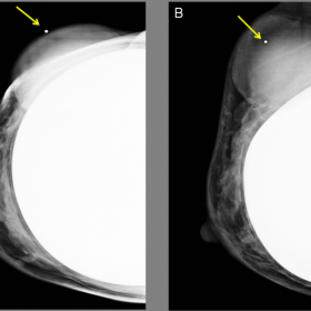 MLO and CC views of the right breast