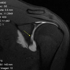 MR shoulder arthrography – Coronal T1 WI with fat saturation