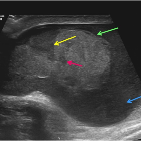 Ultrasound B mode - right scrotal pouch
