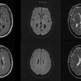 MRI Axial FLAIR sequence and diffusion weighted imaging