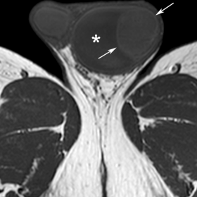 Axial TSE-T1 weighted image
