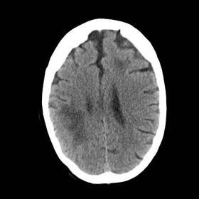 Unenhanced CT of the brain - 3 weeks later