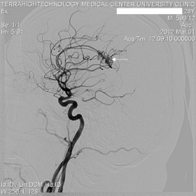 Digital Subtraction Angiography of 28-year-old Male