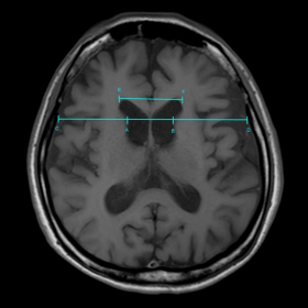 Axial T1W image