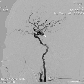 Digital subtraction angiography of 65-year-old female patient