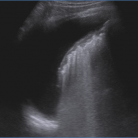 Thoracic sonography