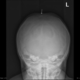 Skull X-ray at age 4 months