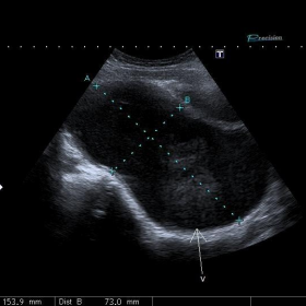 Longitudinal/transverse images of distended vaginal/uterine cavity