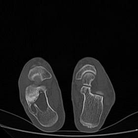 CT foot - Bone window