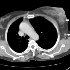 Axial CT Chest - Contrast enhanced study