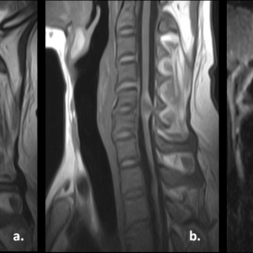 MR images of cervical spine