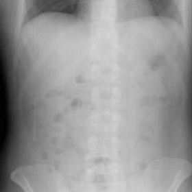 Erect abdominal radiograph