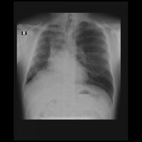 Initial chest radiograph