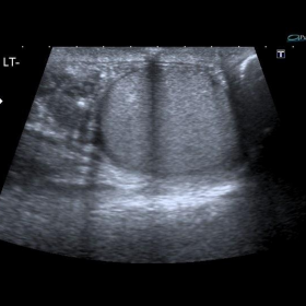 Scrotal ultrasound