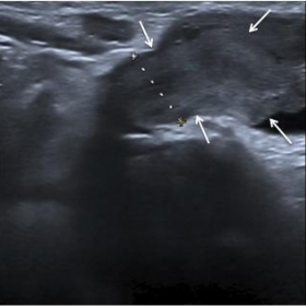 High-frequency ultrasound of the left groin and major labium