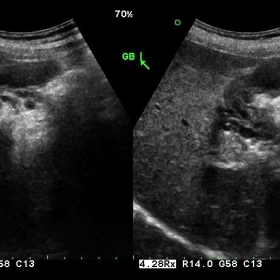 Gallbladder varices ultrasound