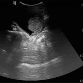 Ultrasound of bladder (longitudinal section)