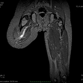 MRI at 6 months after right femoral amputation