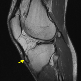 Sagittal PD-w MR image of the knee
