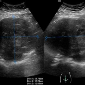 Transverse and longitudinal transabdominal ultrasound images