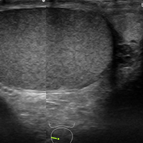 Ultrasound findings of the scrotum