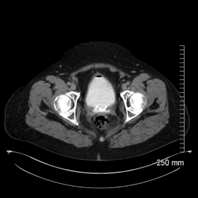 Contrast CT Urogram (Urographic phase) Fig 1