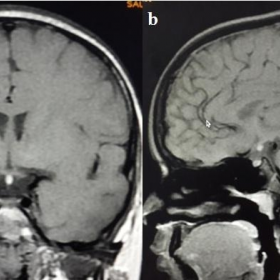 Pituitary dwarf with ectopic neurohypophysis